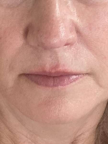 Marionette lines - Botox