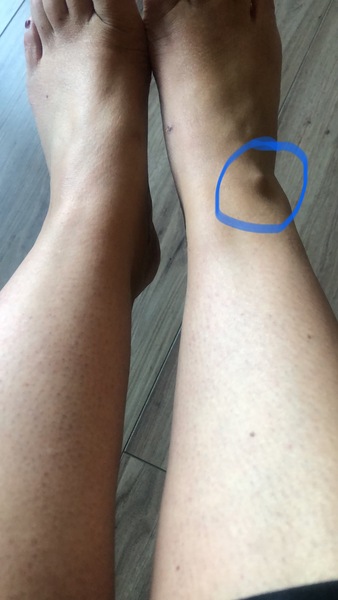 Anyone know what this may be please? Bone spur??