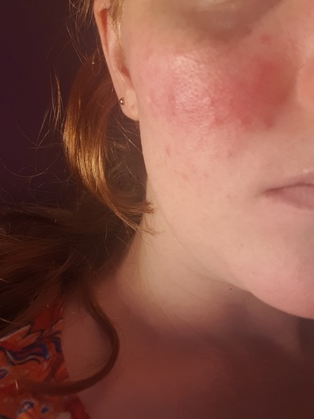Why do I always have spots?