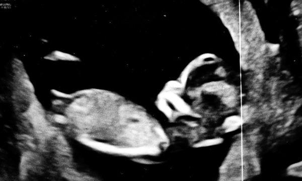 Nub theory - boy or girl?!