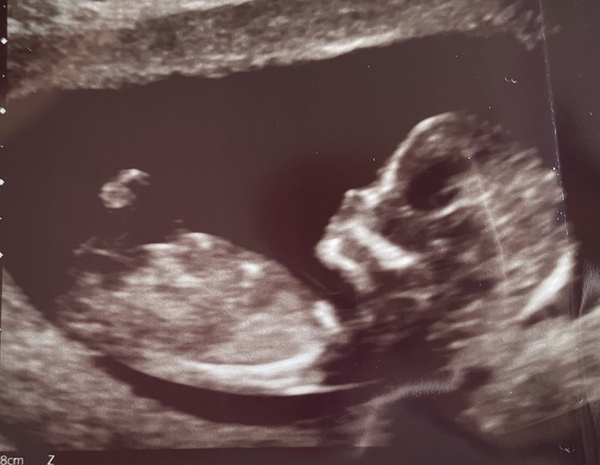13 week ultrasound nub