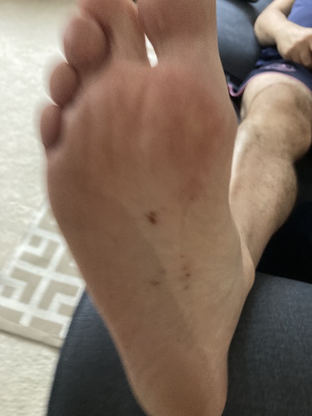 Rash like blotches on foot