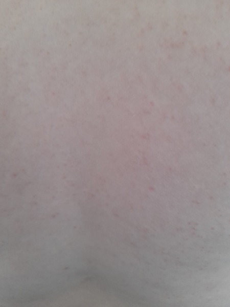Heat rash, scabies or something else... help