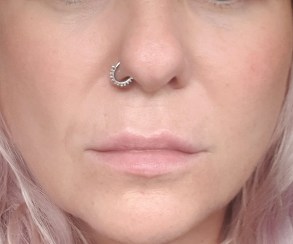 Marionette lines - Botox
