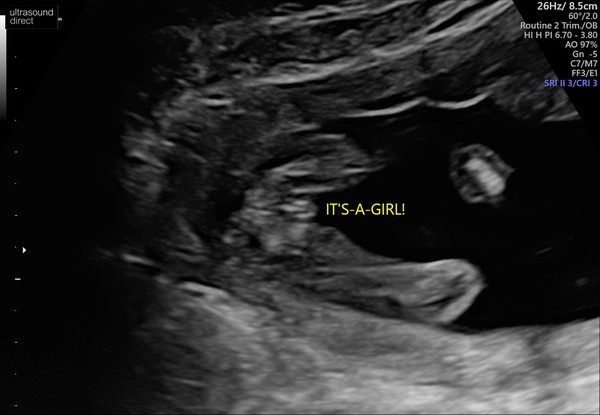 Anyone had a gender scan at 16 weeks?