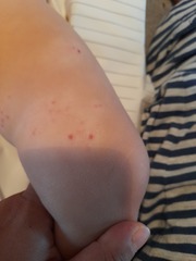 Rash/spots