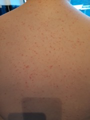 Heat rash, scabies or something else... help