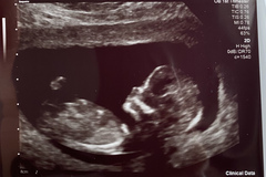 13 week ultrasound nub