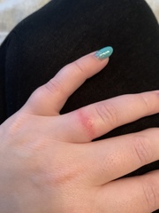 Why am I reacting to my rings?