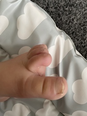 Toenail fungal infection?