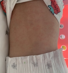 Does this look like roseola?