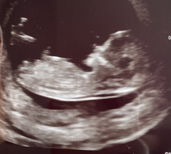 13 week ultrasound nub