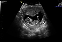 Scan pic boy or girl