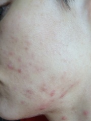 I'm 31 and my skin has gone back to being a teenager!