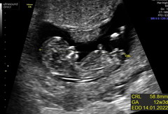 Scan pic boy or girl