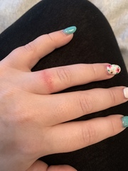 Why am I reacting to my rings?