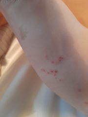 Rash/spots