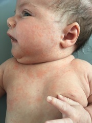Baby acne or Cows Milk Allergy? Photos inc.