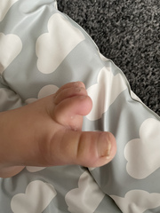 Toenail fungal infection?