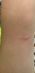 Could this be chicken pox or am I panicking unnecessarily?