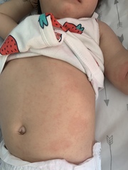 Does this look like roseola?