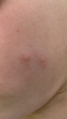 Could this be chicken pox or am I panicking unnecessarily?
