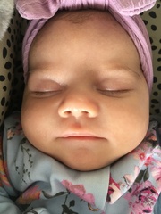 Baby acne or Cows Milk Allergy? Photos inc.