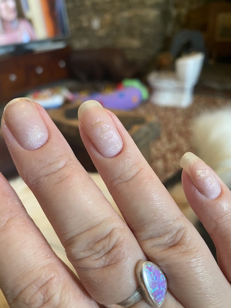 Ridges in nails after pregnancy