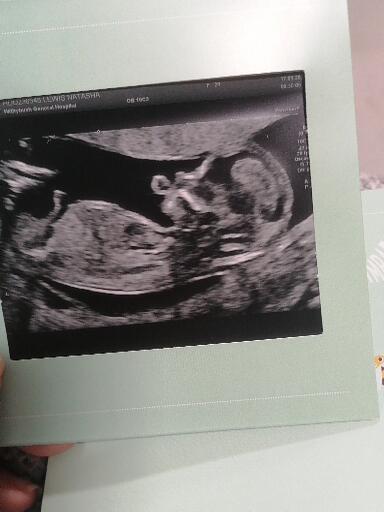 12 weeks scan girl or boy