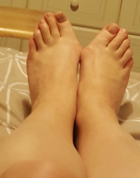 Bunions
