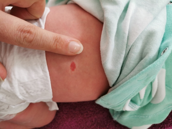 Is this a birthmark?