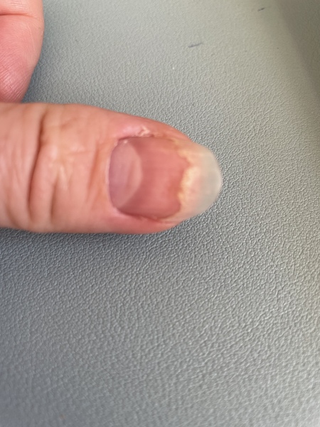 Weird nail - fungal infection?