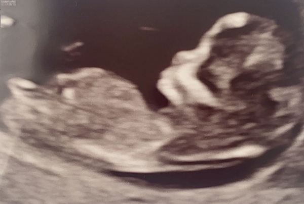 Which gender from scan?