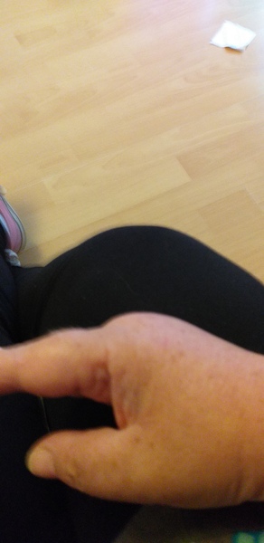 Feeling tired, odema, put in a stone in a month, breathless. Gp insists I am fine.