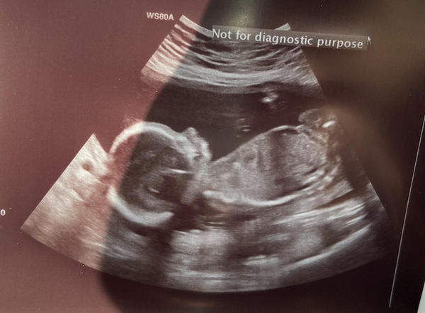 Baby’s sex at 20 weeks (guess?!)