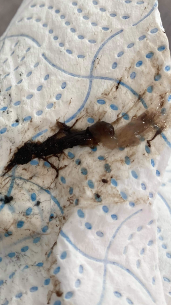 Missed miscarriage *(content warning: contains graphic image)