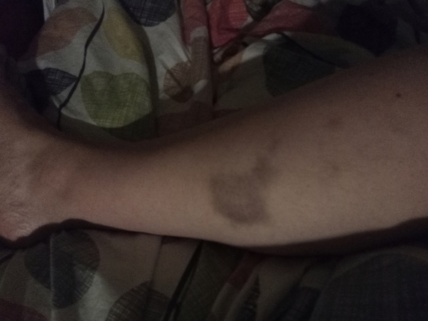 Would you see a GP for unexplained bruising