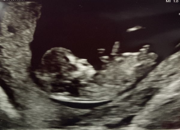 Due March / April 2022 2nd thread 2nd trimester