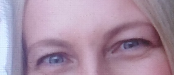 If you had an Upper Blepharoplasty