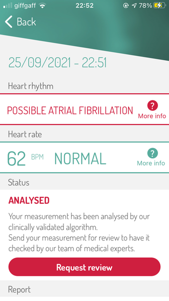 Change in heartbeat after second Pfizer jab