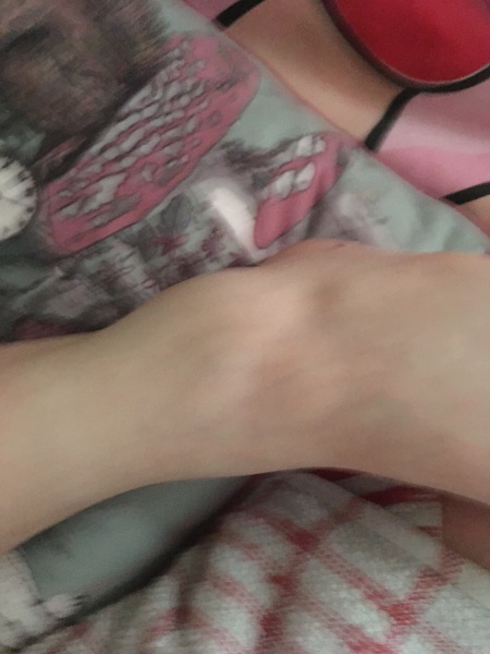 How to tell a sprain from a fracture?