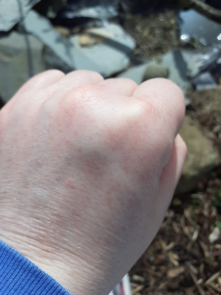 Feeling tired, odema, put in a stone in a month, breathless. Gp insists I am fine.