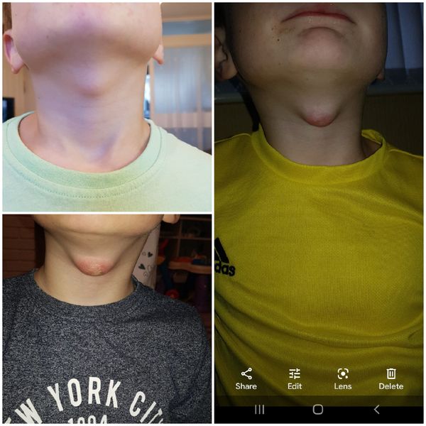 Thyroglossal duct cyst - midline