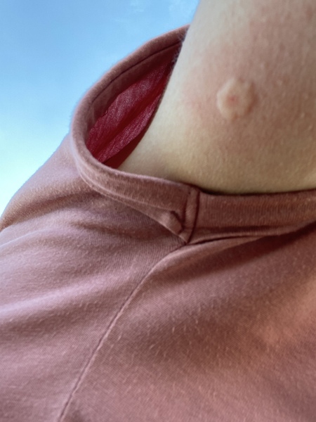 Insect sting