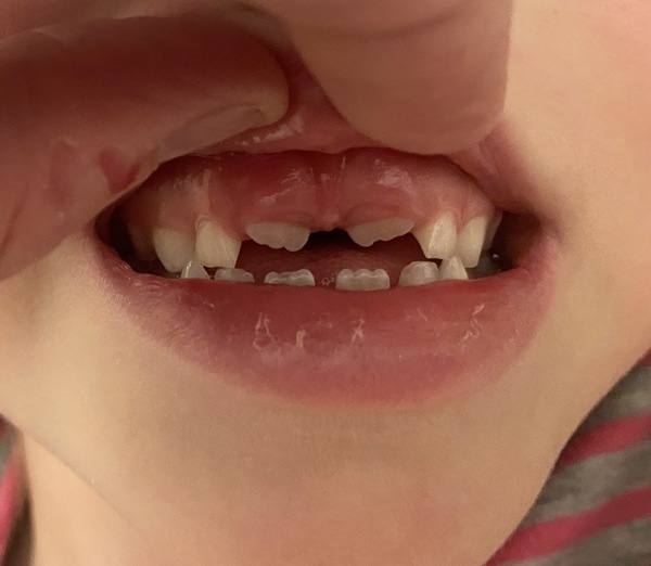 DD7 top front teeth coming at odd angle - should I see the dentist now?