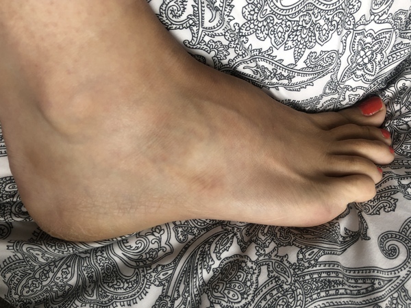 Sprained foot - very painful after 3 months