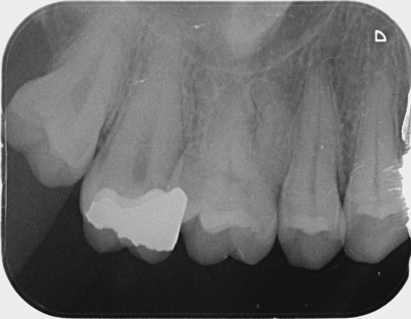 In absolute agony with my wisdom tooth/gum round it
