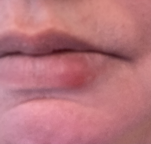 To ask if this looks like a cold sore and if so, how?!