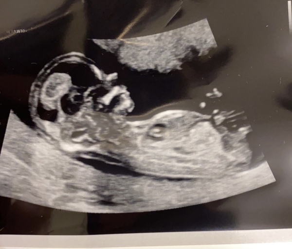 Boy or Girl?