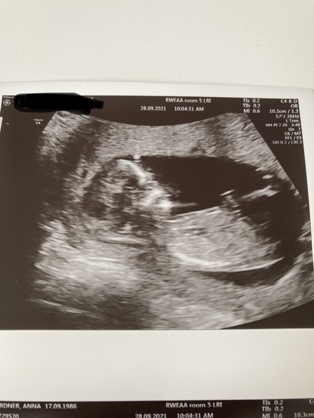 Due March / April 2022 2nd thread 2nd trimester
